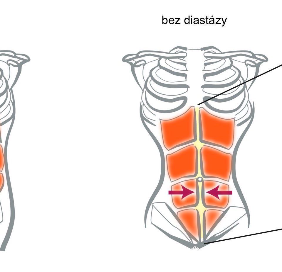 Diastasis recti infographic